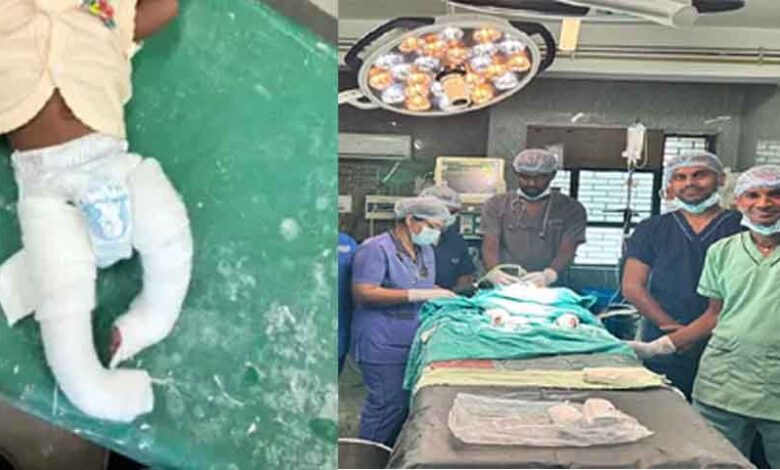 छत्तीसगढ़-बिलासपुर में सिम्स अस्पताल के डाक्टरों का कमाल, टेढ़े पैर वाले तीन सौ बच्चों का सफल ऑपरेशन छत्तीसगढ़-बिलासपुर में सिम्स अस्पताल के डाक्टरों का कमाल, टेढ़े पैर वाले तीन सौ बच्चों का सफल ऑपरेशन