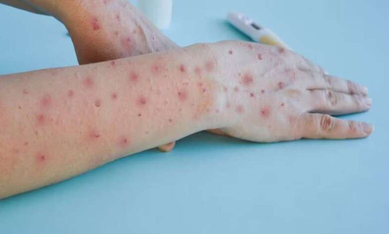 बंदर से फैली बीमारी ने लिया विकराल रूप, 1260 मृत और 70 हजार प्रभावित