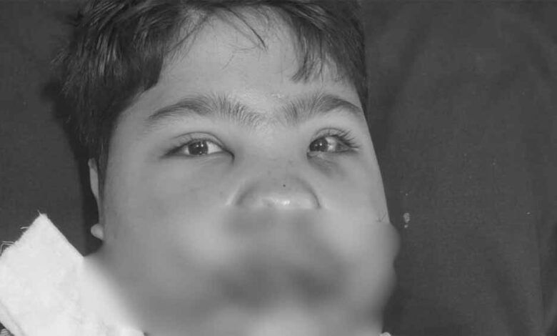 MP में फ्रिज फटा: मासूम की 108 हड्डियां टूटी, डॉक्टरों ने 5 घंटे में लौटाई जिंदगी